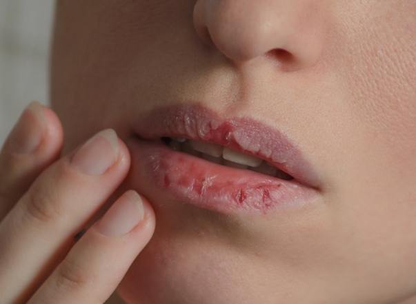 嘴唇乾裂預防