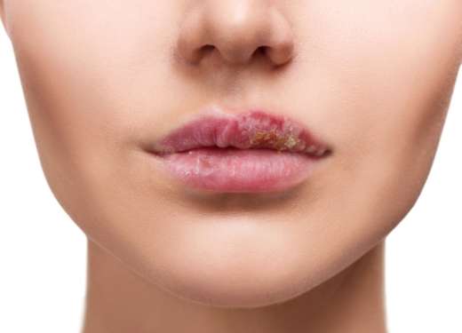 嘴唇乾裂怎麼辦