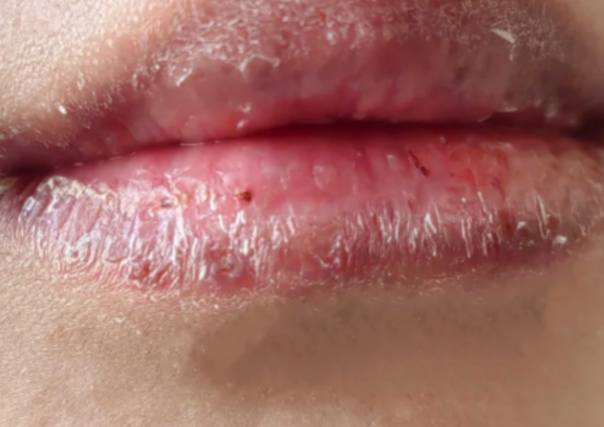 嘴唇乾裂怎麼辦