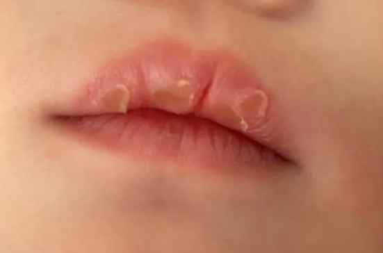 嘴唇乾裂怎麼辦